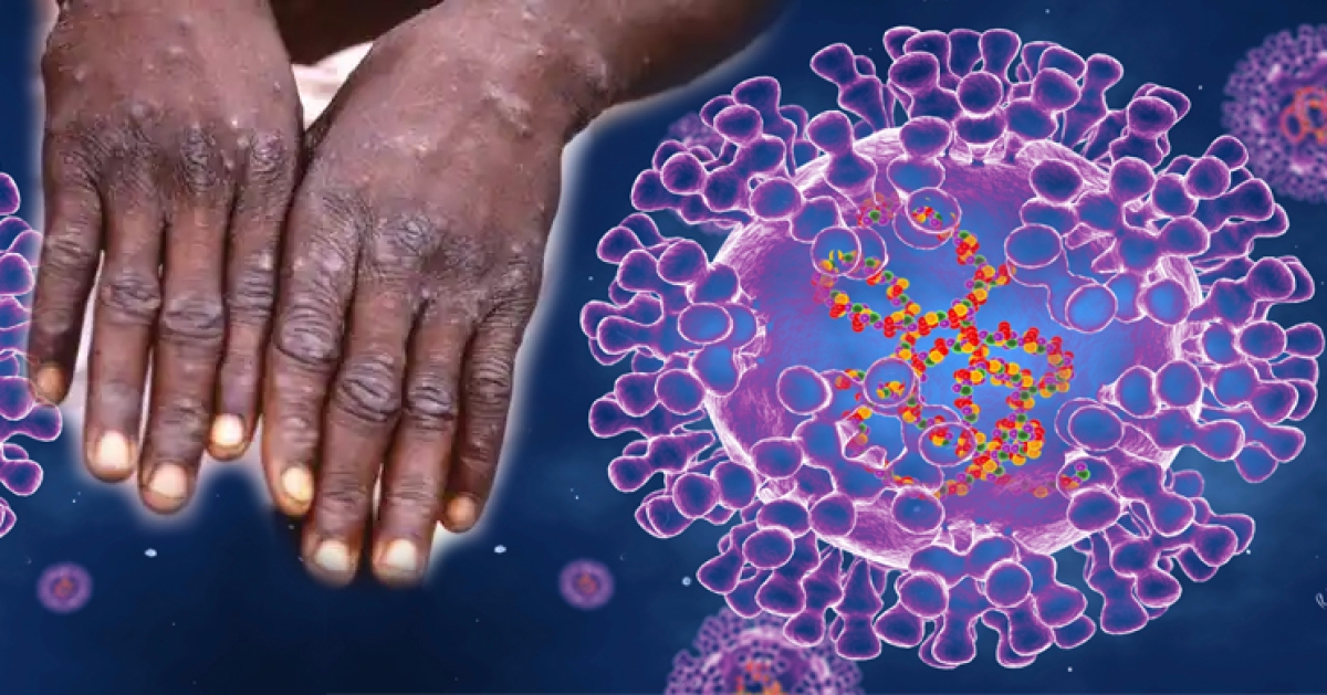 First Monkeypox case reported in Sri Lanka