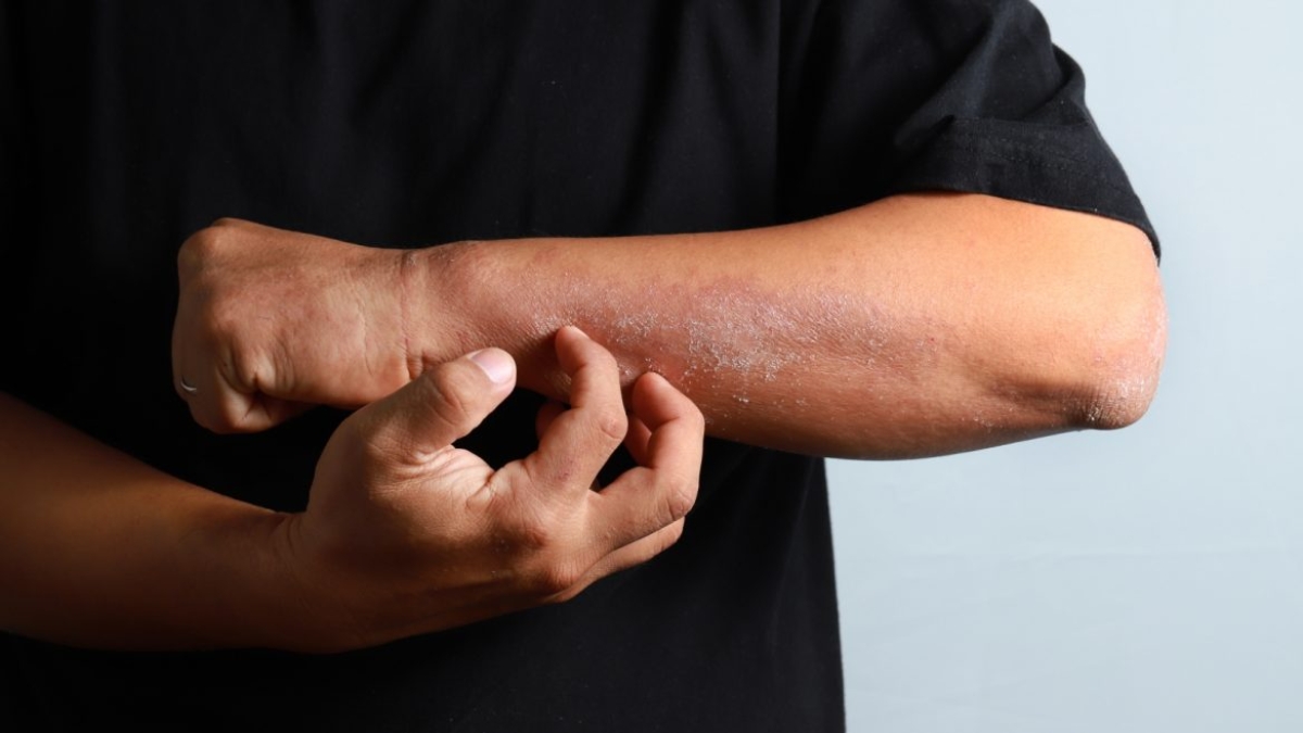 Medical experts warn of skin disease spreading rapidly in Sri Lanka