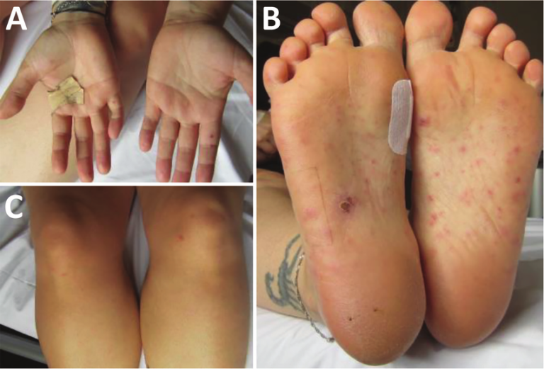 Rat Fever Confirmed in Seven Fever-Related Deaths in North